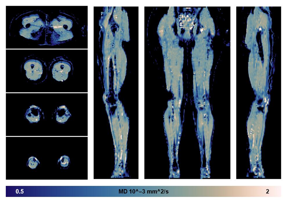 IVIM corrected whole leg muscle mean diffusivity obtained from diffusion tensor imaging.